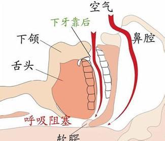 睡觉老是打呼噜怎么办?